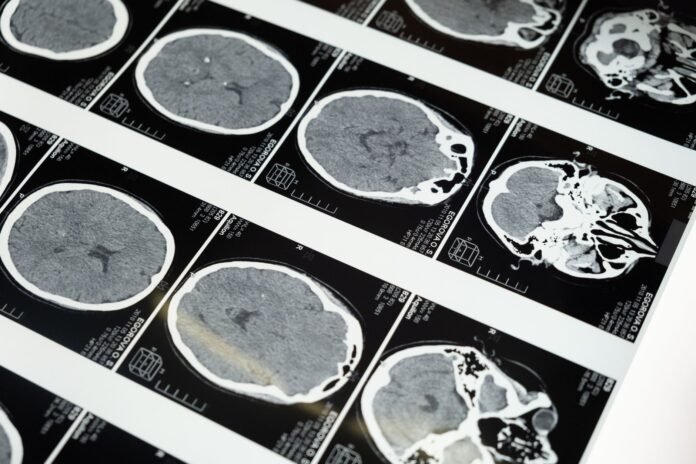 Un bărbat de 45 de ani din Mărăcineni a murit după un accident vascular cerebral